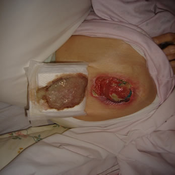 wound1nov25